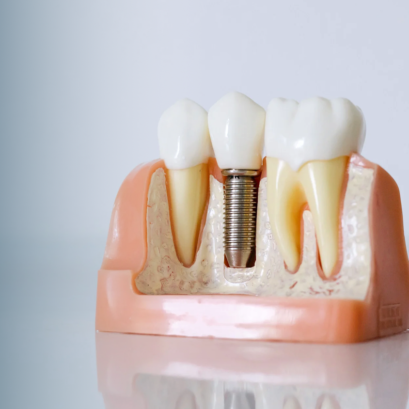 Implante dentário